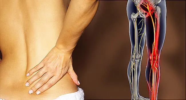 650x350_sciatica_overview_slideshow 650x350_sciatica_overview_slideshow